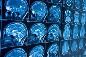 MRI images of brain