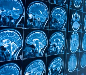 MRI images of brain