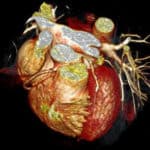 Coronary CT Angiogram