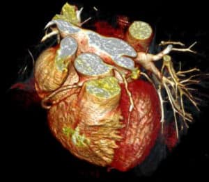 Contrast enhanced 3D rendering coronary CTA